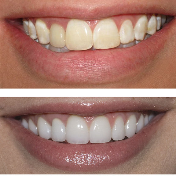 Christmas Deal Sparkle White Teeth Whitening Kit w/ Free Gift