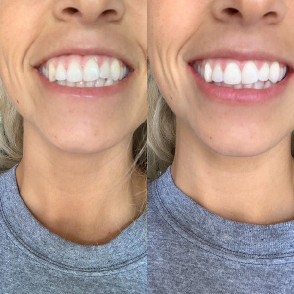 Stellar White Advanced Teeth Whitening Kit